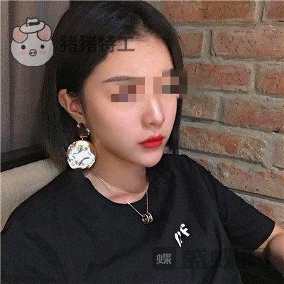 北京润美玉之光,王明利,面部填充,案例,价格,