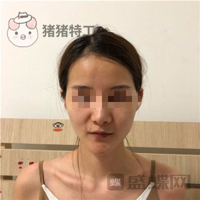 福州美贝尔,原上海九院,赵栋材,面部填充,案例,价格,