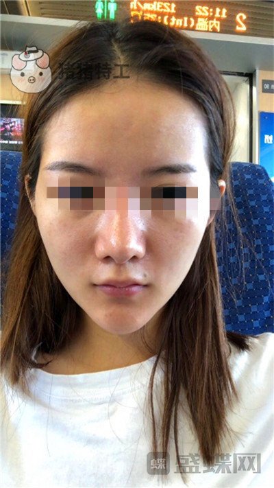 福州美贝尔,原上海九院,赵栋材,面部填充,案例,价格,