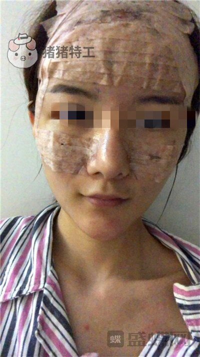 福州美贝尔,原上海九院,赵栋材,面部填充,案例,价格,