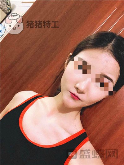 福州美贝尔,原上海九院,赵栋材,面部填充,案例,价格,