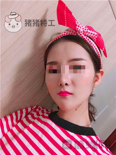 福州美贝尔,原上海九院,赵栋材,面部填充,案例,价格,