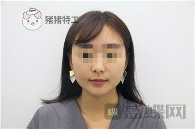 北京俊泰丽格,薛志强,埋线提升,案例,价格,