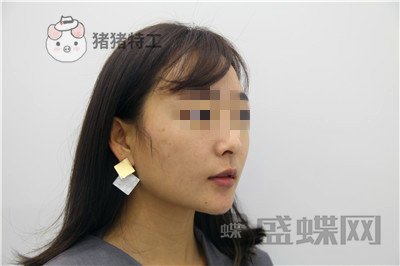 北京俊泰丽格,薛志强,埋线提升,案例,价格,