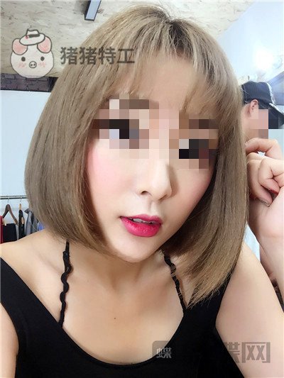 北京俊泰丽格,薛志强,埋线提升,案例,价格,