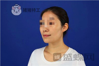 重庆华美,陈凯,面部填充,案例,价格,