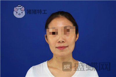 重庆华美,陈凯,面部填充,案例,价格,