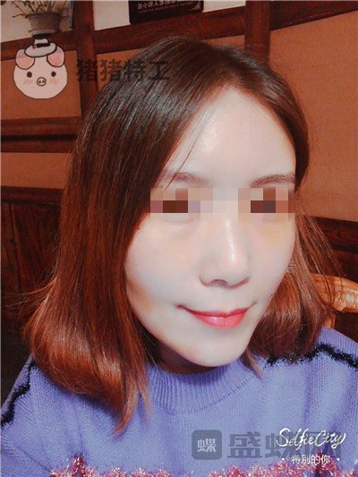 重庆华美,陈凯,面部填充,案例,价格,