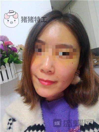 重庆华美,陈凯,面部填充,案例,价格,