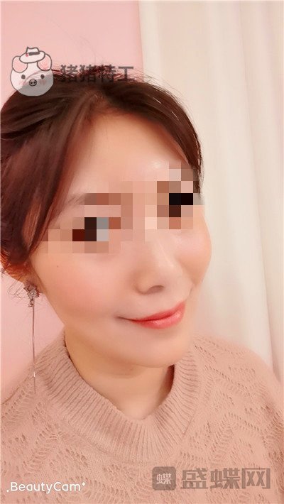 重庆华美,陈凯,面部填充,案例,价格,