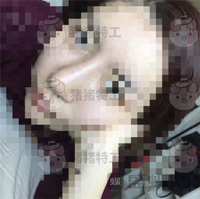 上海九院,张盈帆,鼻修复,案例,价格,