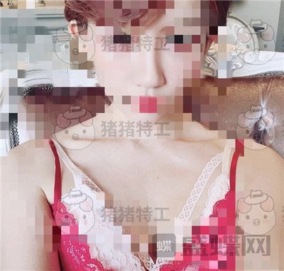 上海九院,张盈帆,鼻修复,案例,价格,
