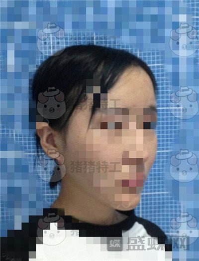 北京八大处,解芳,下巴截骨,案例,价格,