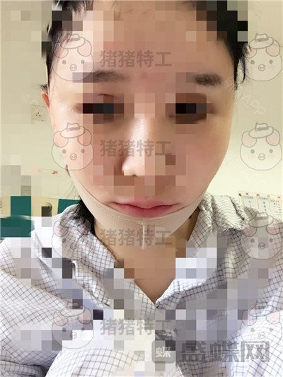北京八大处,解芳,下巴截骨,案例,价格,