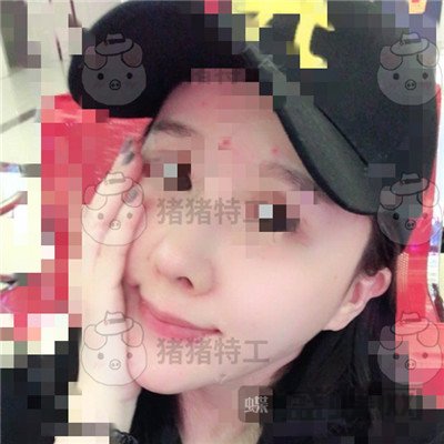 北京八大处,解芳,下巴截骨,案例,价格,