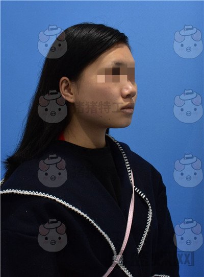 重庆万家燕,王珍祥,颧骨内推,案例,价格,