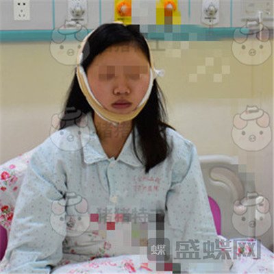 重庆万家燕,王珍祥,颧骨内推,案例,价格,