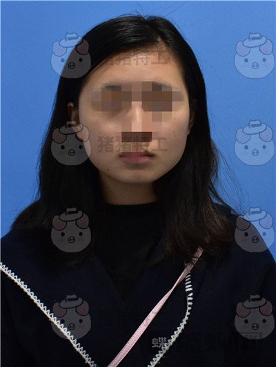 重庆万家燕,王珍祥,颧骨内推,案例,价格,