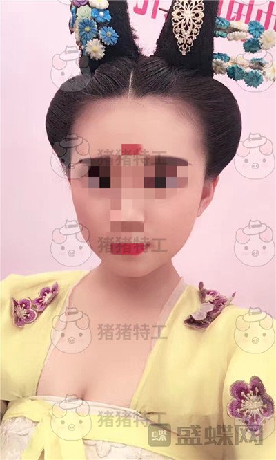 重庆万家燕,王珍祥,颧骨内推,案例,价格,