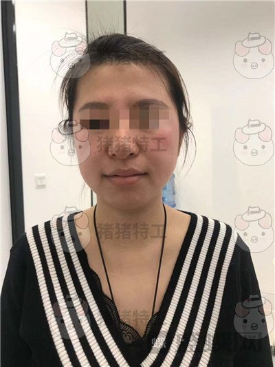 成都八大处,唐勇,面部填充,案例,价格,