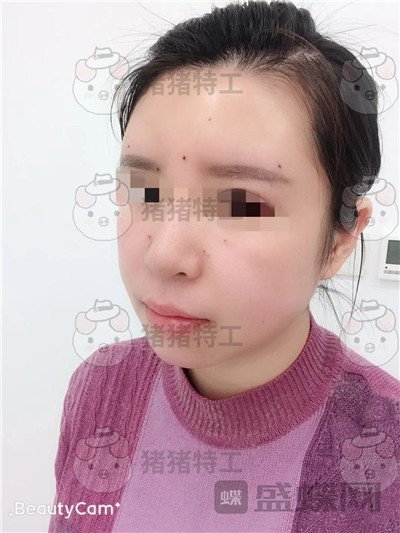 成都八大处,唐勇,面部填充,案例,价格,