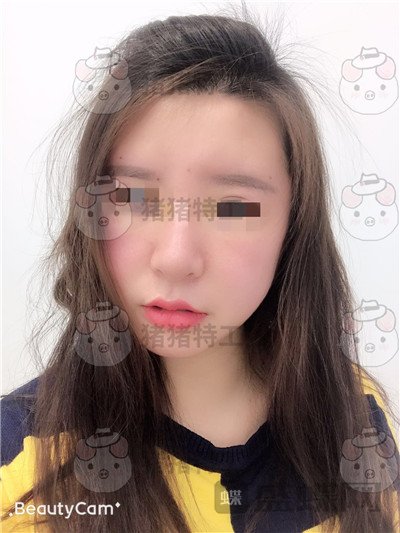 成都八大处,唐勇,面部填充,案例,价格,