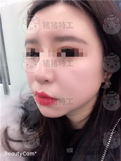成都八大处,唐勇,面部填充,案例,价格,