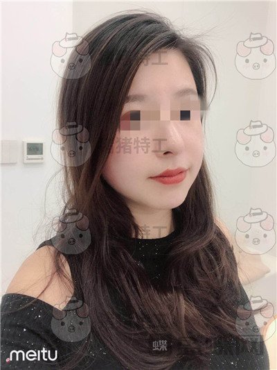 成都八大处,唐勇,面部填充,案例,价格,