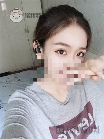 杭州美莱,韩超,双眼皮,案例,价格,