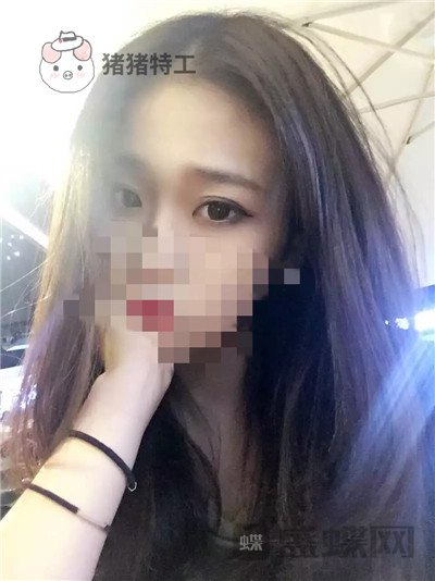 杭州美莱,韩超,双眼皮,案例,价格,