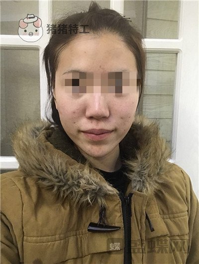 北京润美玉之光,王明利,面部填充,案例,价格,