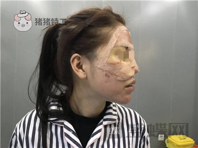 北京润美玉之光,王明利,面部填充,案例,价格,