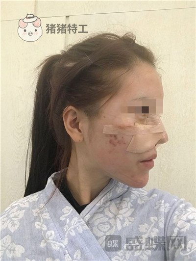 北京润美玉之光,王明利,面部填充,案例,价格,