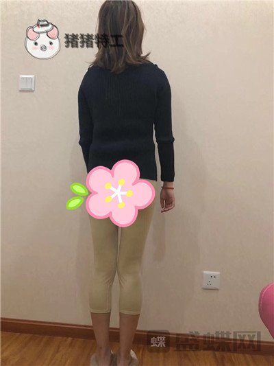 昆明梦想整形,李成龙,吸脂,案例,价格,