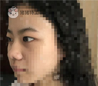 上海百达丽,周珍艳,双眼皮,鼻部手术,案例,价格,