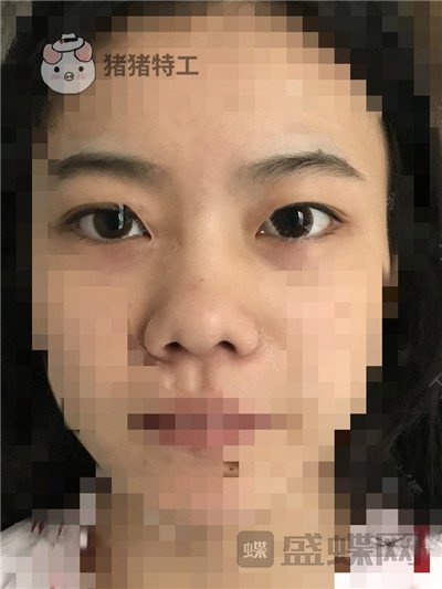 上海百达丽,周珍艳,双眼皮,鼻部手术,案例,价格,