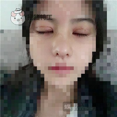 上海百达丽,周珍艳,双眼皮,鼻部手术,案例,价格,