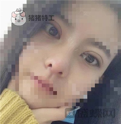 上海百达丽,周珍艳,双眼皮,鼻部手术,案例,价格,