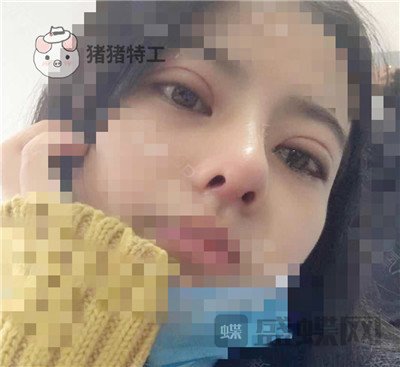 上海百达丽,周珍艳,双眼皮,鼻部手术,案例,价格,