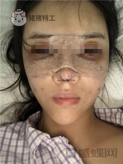 上海华美,李健,面部填充,案例,价格,