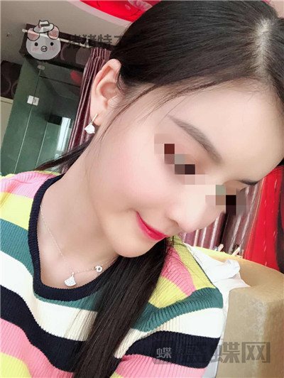 上海华美,李健,面部填充,案例,价格,