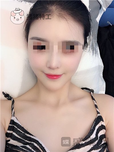 上海华美,李健,面部填充,案例,价格,