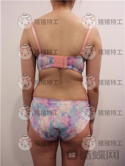 重庆瑞俪,胡小义,吸脂,案例,价格,
