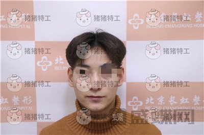 北京长虹,于志宏,鼻部手术,案例,价格,