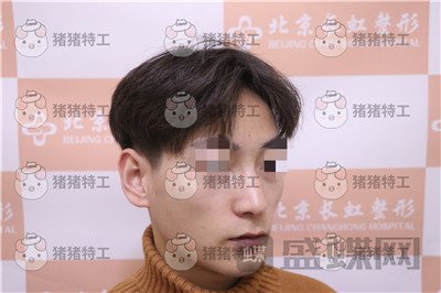 北京长虹,于志宏,鼻部手术,案例,价格,