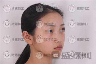 长沙南湖,何怀万,隆鼻,案例,价格,