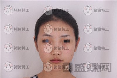 长沙南湖,何怀万,隆鼻,案例,价格,