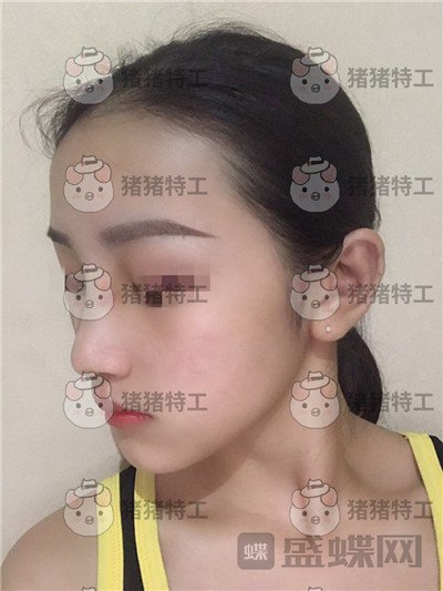 长沙南湖,何怀万,隆鼻,案例,价格,