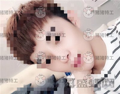 上海华美,叶丽萍,垫下巴,案例,价格,