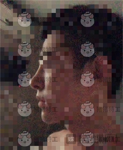 上海华美,叶丽萍,垫下巴,案例,价格,